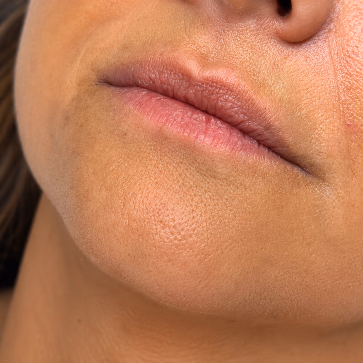 Antes del tratamiento — Labios