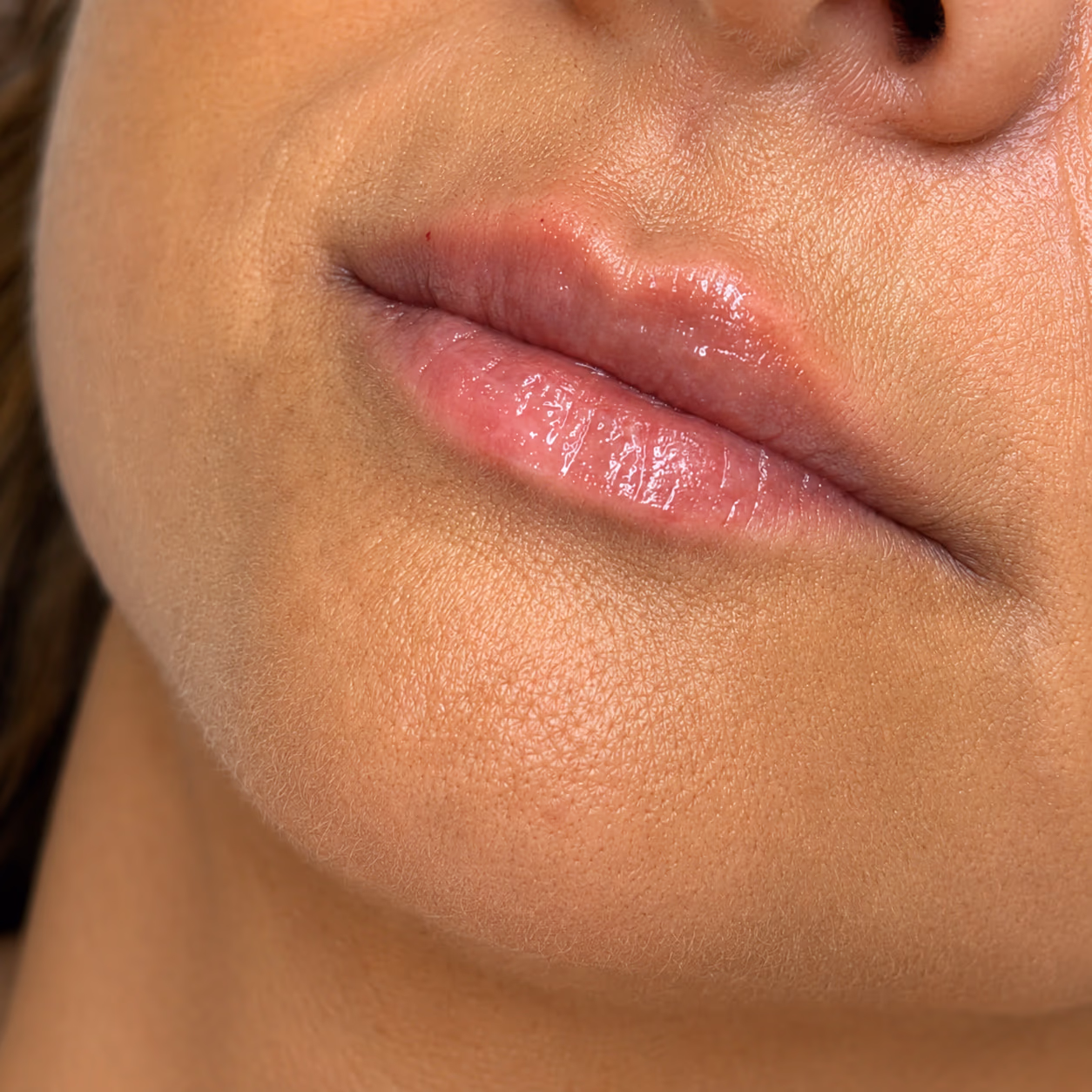 Después del tratamiento — Labios